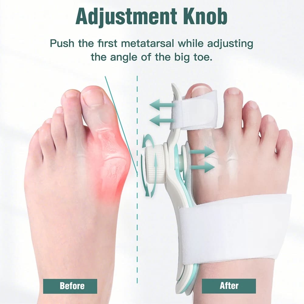 Orthopedic bunion corrector, hallux valgus corrector sa paa